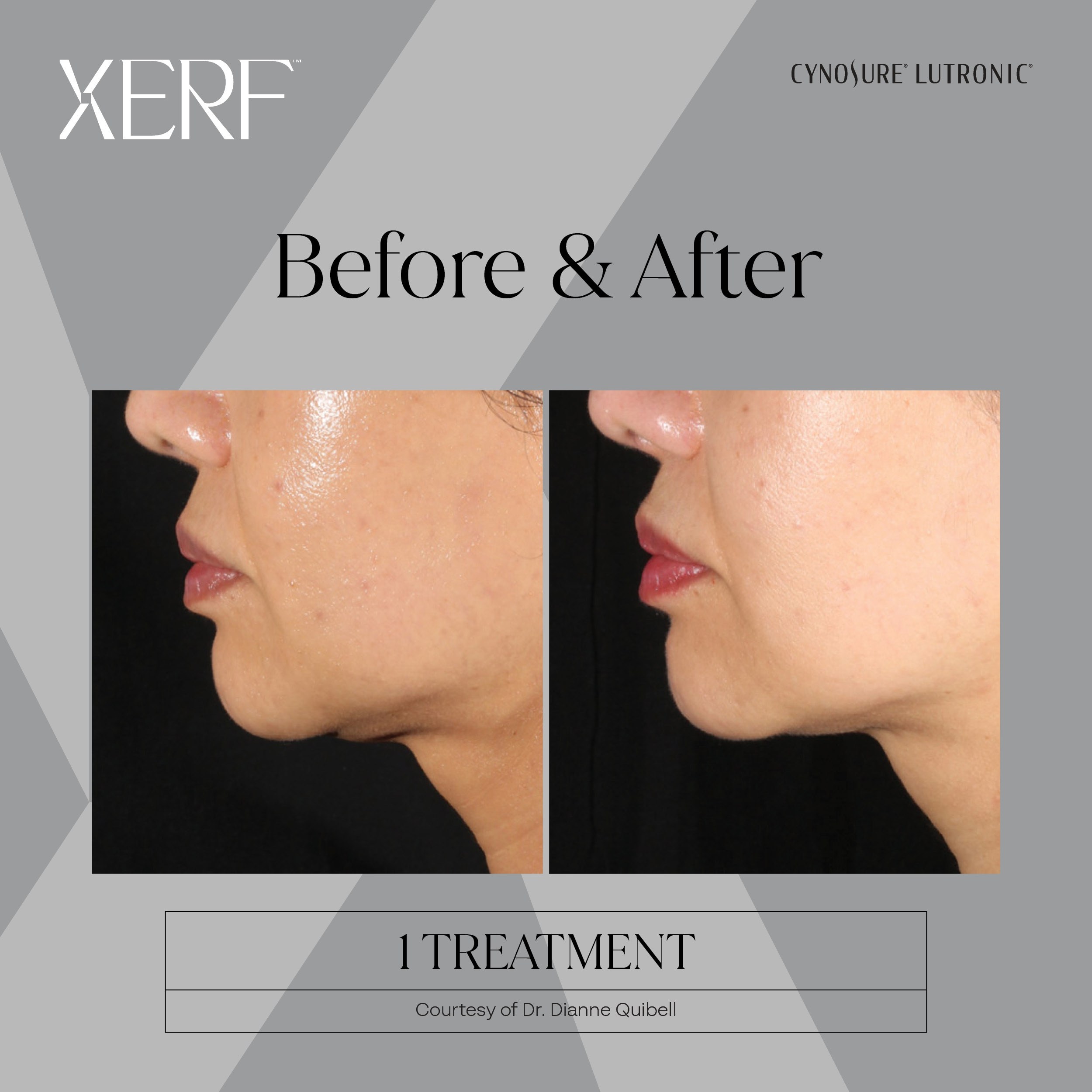 XERF before and after result 1
