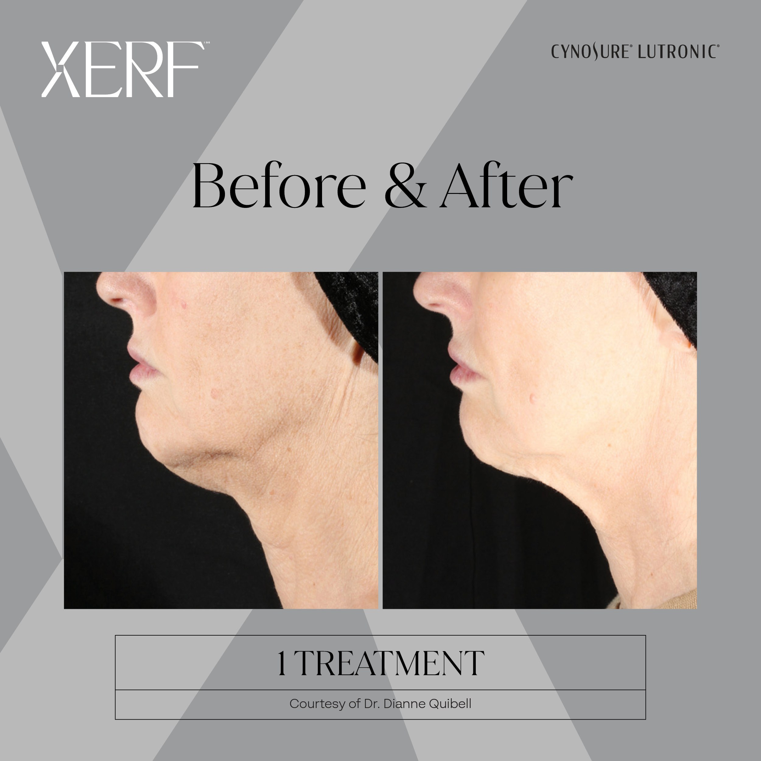 XERF before and after result 2