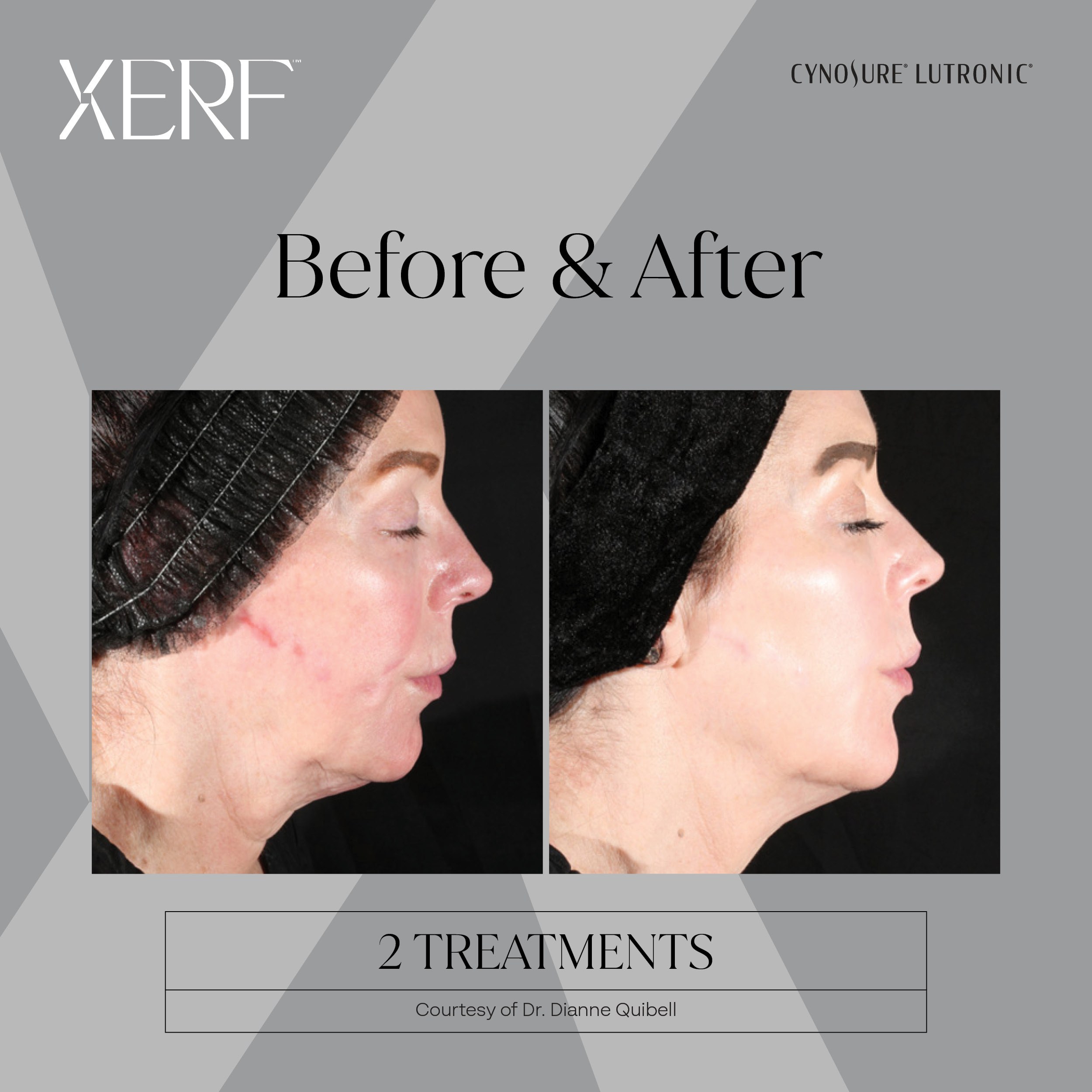 XERF before and after result 3