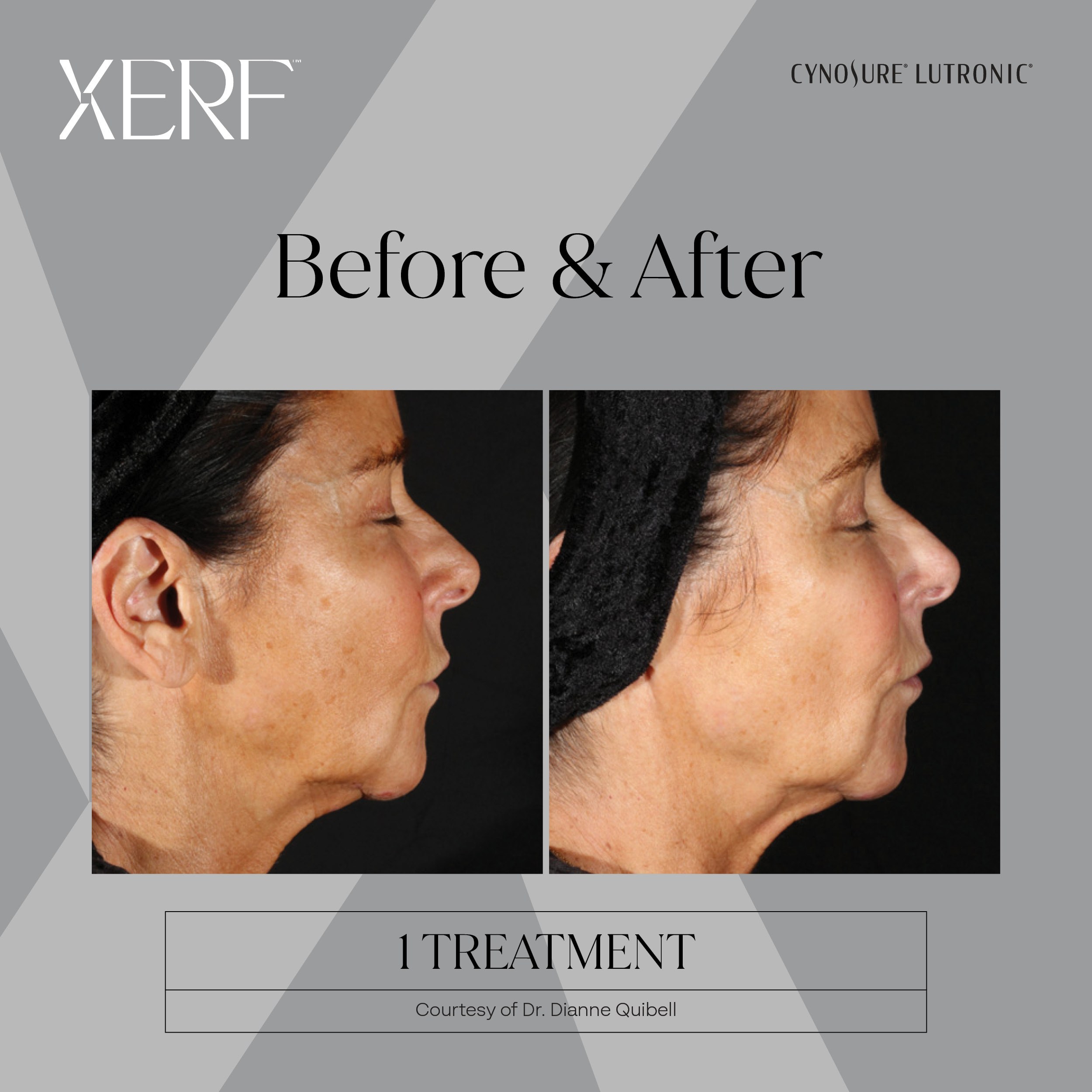 XERF before and after result 4